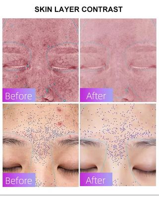 acheter Blue Light Acne Treatment Mask with Intelligent Timer – Manufacturer Direct Supply, Appearance Patent Included fabrication en ligne